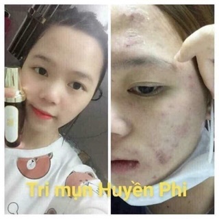 Mặt nạ mụn Huyền Phi(120k)