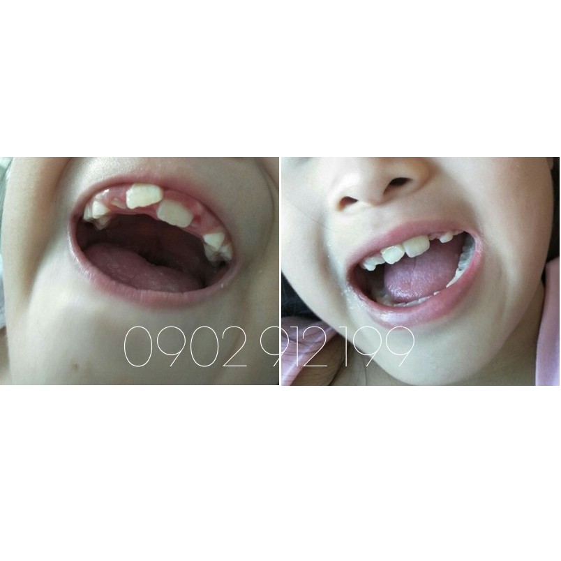 Bộ niềng răng tại nhà cho bé từ 7-12 tuổi| A1+A2