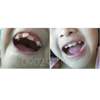 NIỀNG RĂNG TẠI NHÀ CHO BÉ [A1+A2]