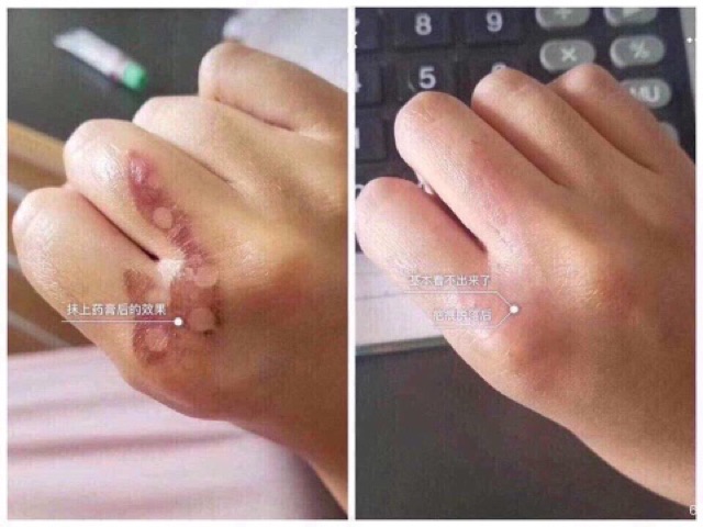 Kem Hỗ Trợ Cải Thiện Sẹo Gentacin Nhật Bản