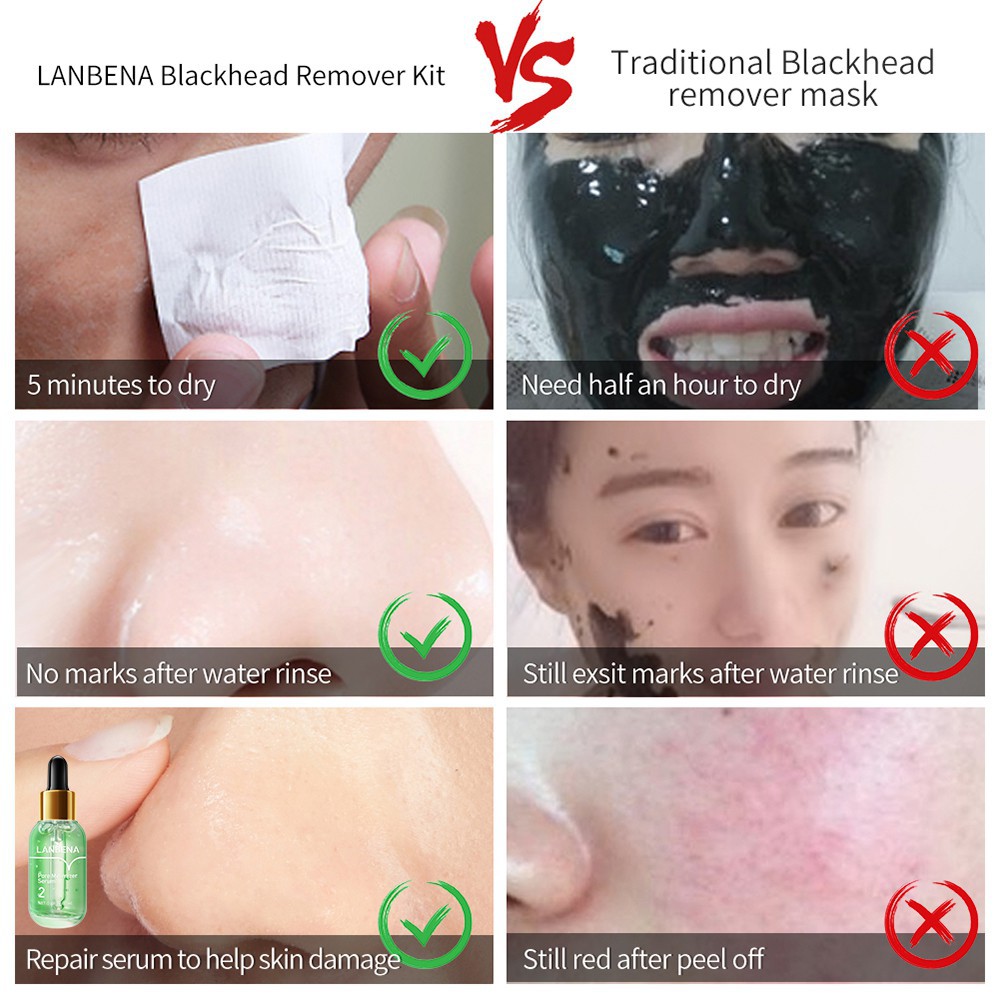 Chai mặt nạ lột mụn đầu đen se khít lỗ chân lông lanbena 17ml kèm 100 miếng dán