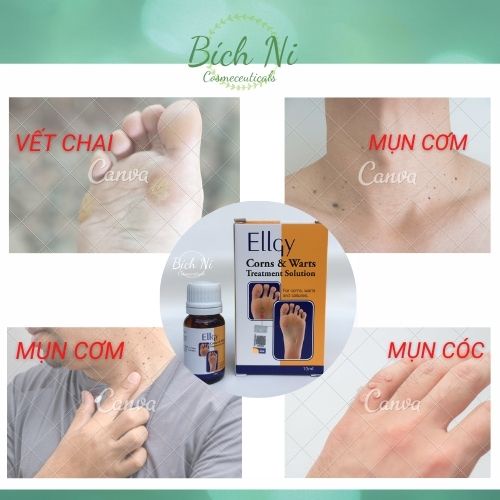 Dung dịch Ellgy Corns &amp; Warts loại sạch mụn cóc, mụn cơm, chai mắt cá chân.