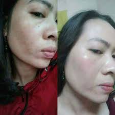 KEM VỖ BONG CHO DA NÁM LÀM TRẮNG DA Dr.Snow