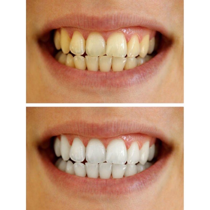 Miếng dán trắng răng Crest 3D White - Gói lẻ gồm 2 miếng dán giúp trắng răng, thơm miệng
