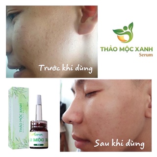 Thảo Mộc Xanh Serum ❗Free Ship