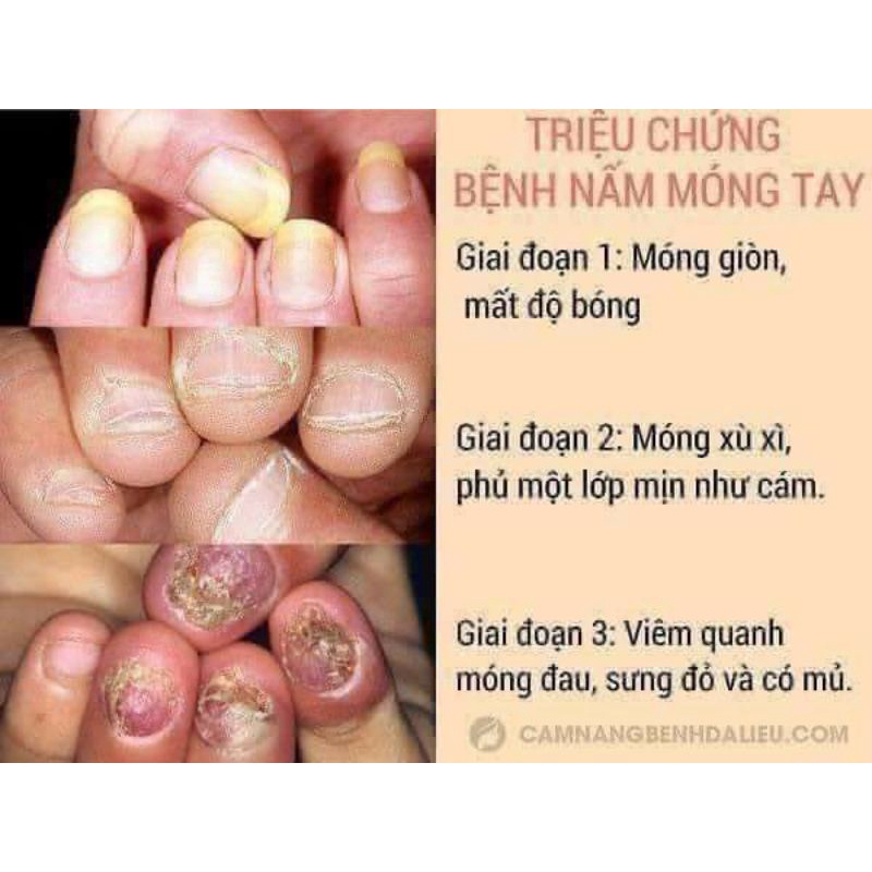 Điều trị nấm móng Varisi