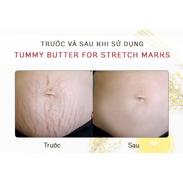 Kem Palmer Tummy Butter Stretch Marks Hũ 125g