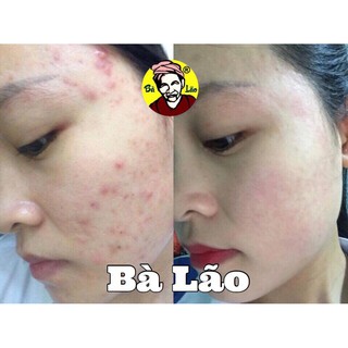 Combo Tái Tạo Cao Cấp Bà Lão