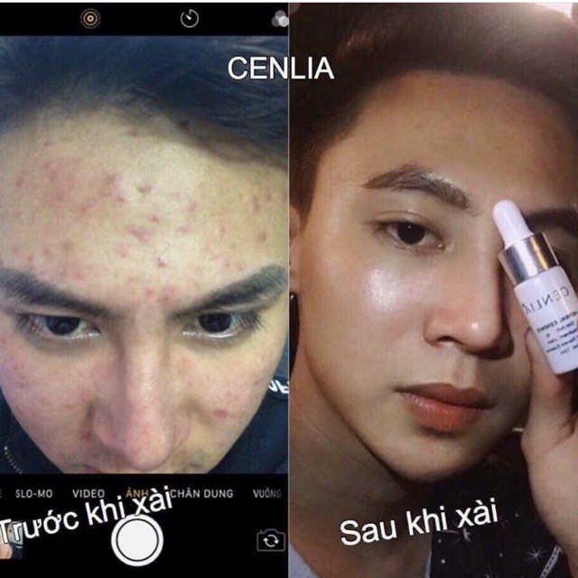 Essence CENLIA 🔥[ CHÍNH HÃNG ] tạm biệt mụn, tạm biệt lỗ chân lông to, không để lại sẹo thâm, giúp da mịn màng sạch mụn | BigBuy360 - bigbuy360.vn