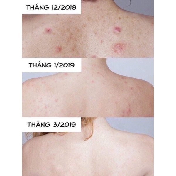 Xà Phòng Trị Mụn Lưng, Viêm Nang Lông