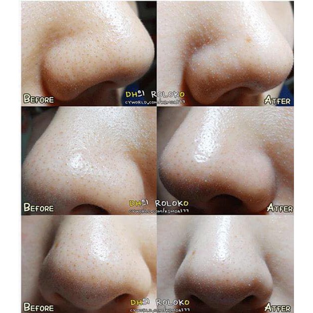 [CHÍNH HÃNG] Lẻ miếng dán đẩy mụn đầu đen, mụn cám Goodbye Blackhead Ciracle