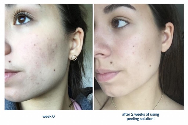 Serum tẩy tế bào chết The Ordinary AHA 30% + BHA 2% Peeling Solution | BigBuy360 - bigbuy360.vn