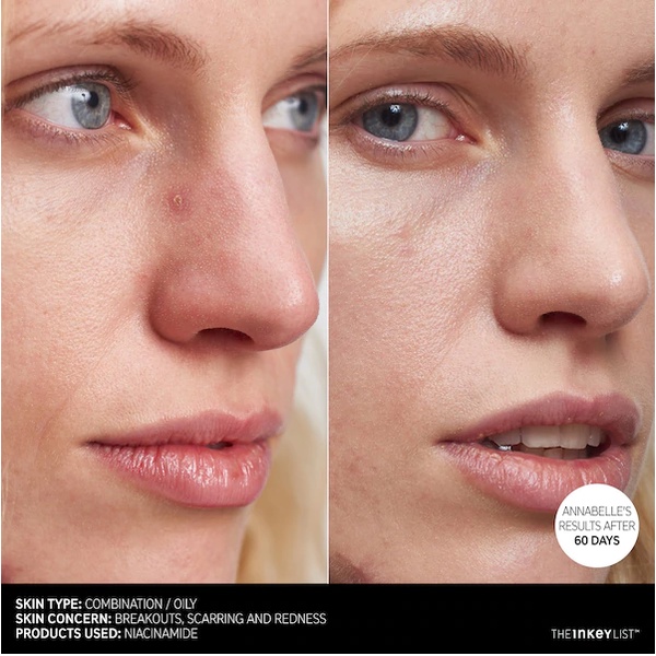 Tinh chất giảm mụn, mờ thâm The InKey List Niacinamide 30ml