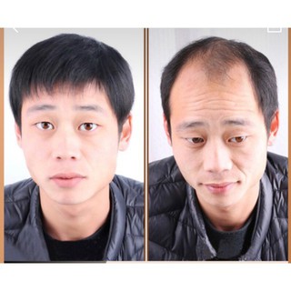 Che hói nam - tóc giả che hói cho nam - kèm ảnh thật