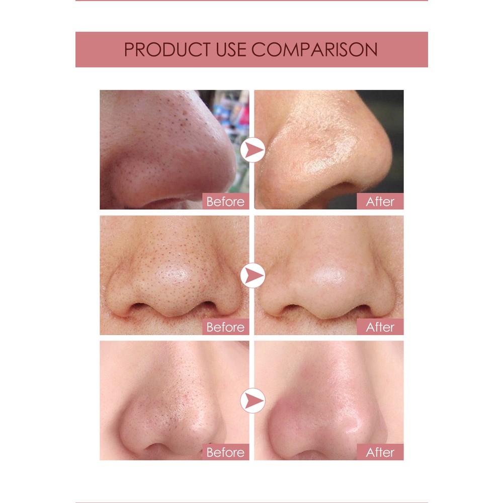Miếng Dán Mũi Lột Mụn Đầu Đen Kiềm Dầu Kimuse