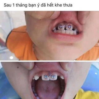 Loop đóng khoảng răng cửa