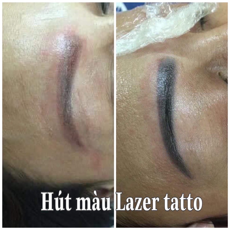 Hút màu mực xăm ko cần máy lazer