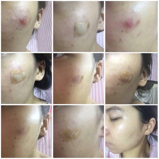 MIẾNG DÁN MỤN DUODERM