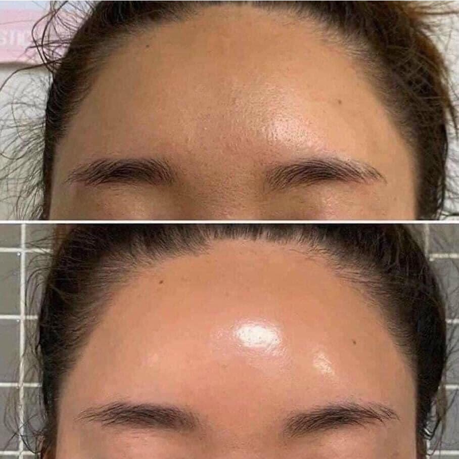 Kem Retinal 1% Lumiderm Retinal Advanced - A 1.0 Cream