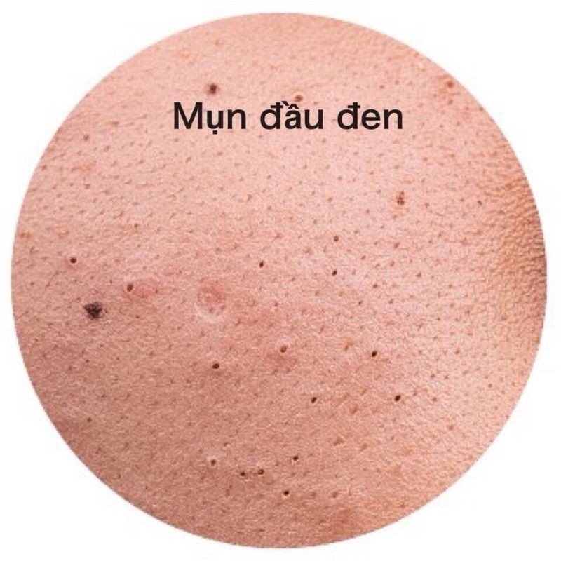 Gell rửa mặt mụn đầu đen than hoạt tính Propeller PoreVacuum | BigBuy360 - bigbuy360.vn