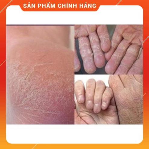 Kem bôi nấm ngứa, tổ đỉa, hắc lào, lang ben, vảy nến, á sừng, zona các vấn đề về da