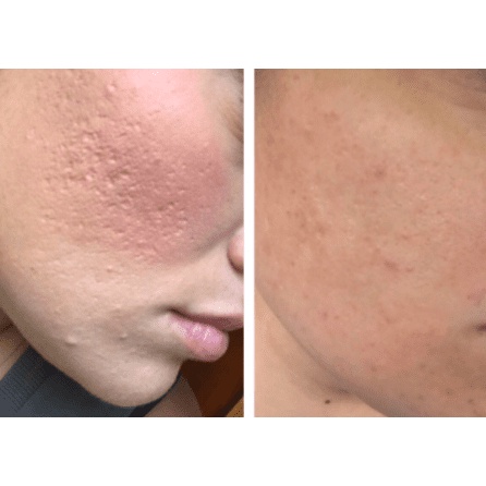 Peel chấm TCA 50%,75%, 80% Làm Đầy Sẹo Rỗ Sẹo Lõm Splendora | TRICHLOROACETIC ACID - Tặng kèm bao tay y tế