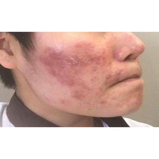 Thảo Dược Hết Hẳn bong tróc, ngứa, lột vảy trắng từng mảng da mặt, khóe mũi, cằm, sau vành tai (Đông Y Cổ Truyền)