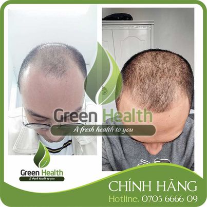 Dung dịch mọc râu tóc Minoxidil 10% Tugain