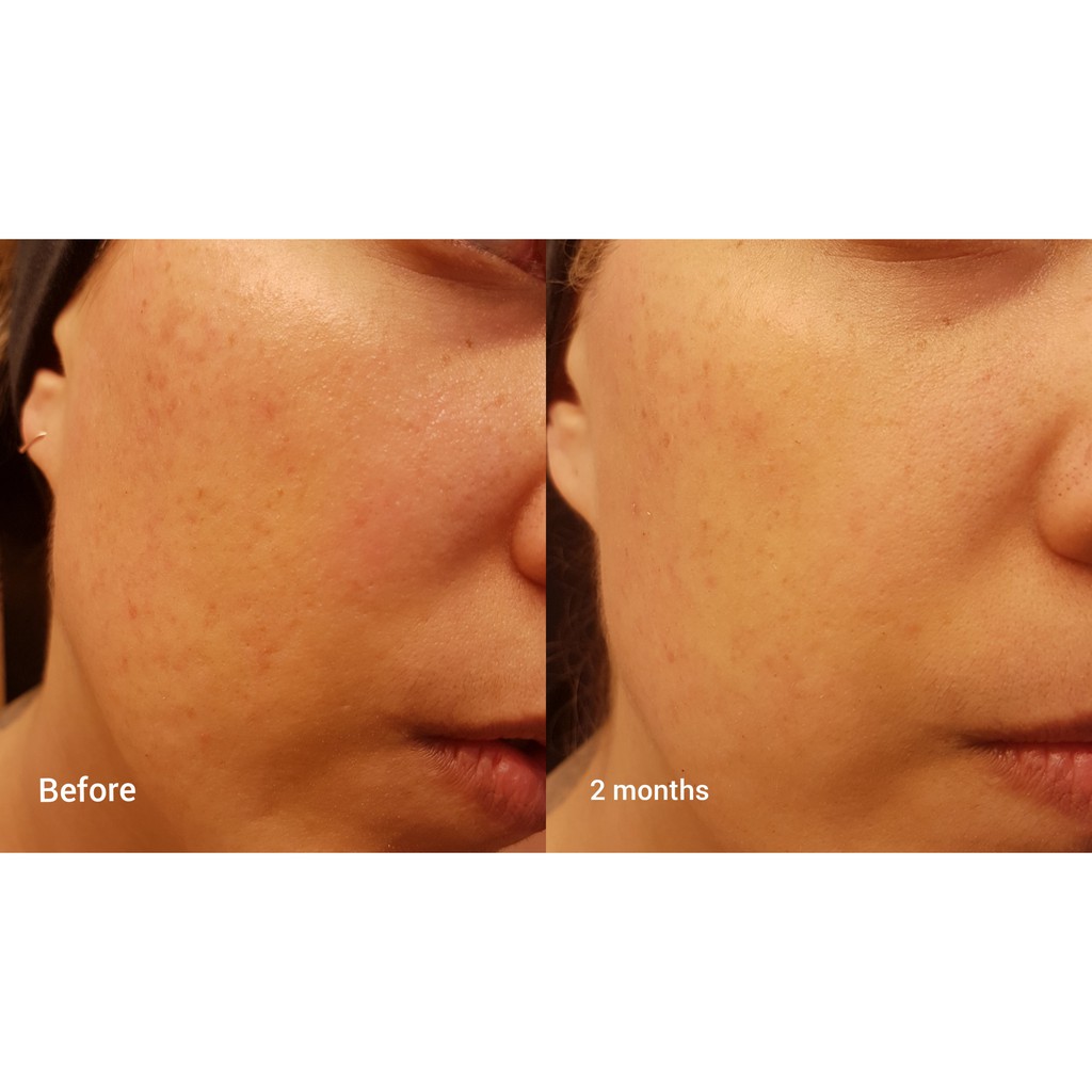 Niod serum Repigment mờ nám, đốm nâu, tàn nhang bill canada