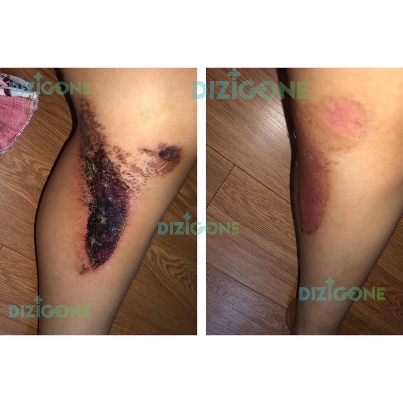 Dizigone spray 100ml xịt kháng khuẩn, tái tạo da, ngăn ngừa sẹo - CN106