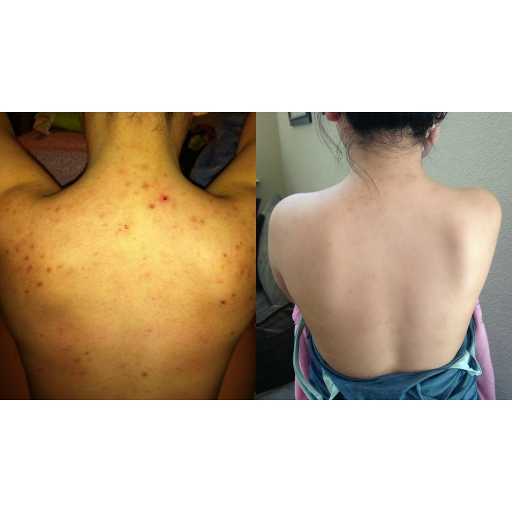 Xà Phòng Baresoul Giảm Mụn Lưng Và Mờ Thâm Herbal Scrub & Soap 100g - Begu | BigBuy360 - bigbuy360.vn