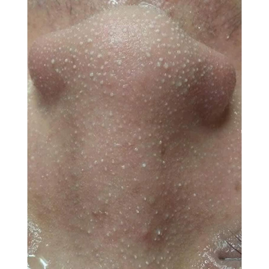 Ủ Mụn Đầu Đen. Ủ Mụn Cám Chuyên Dụng trong Spa, TMV