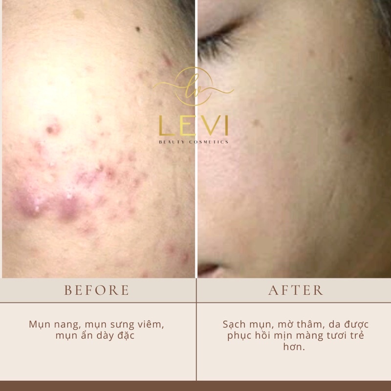 Serum mụn LEVI mờ thâm, trắng da, sạch mụn 100% sau 7 ngày | BigBuy360 - bigbuy360.vn