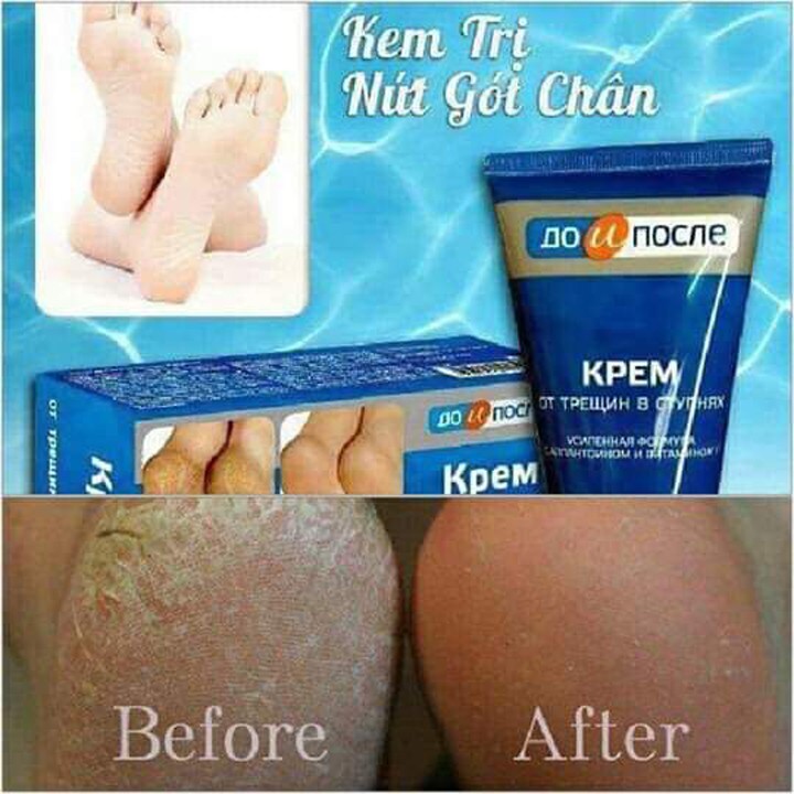 Kem nứt gót chân Nga Kpem,dưỡng da chân,Ngăn Ngừa Và Hồi Phục Nứt Nẻ Gót Chân 50ml