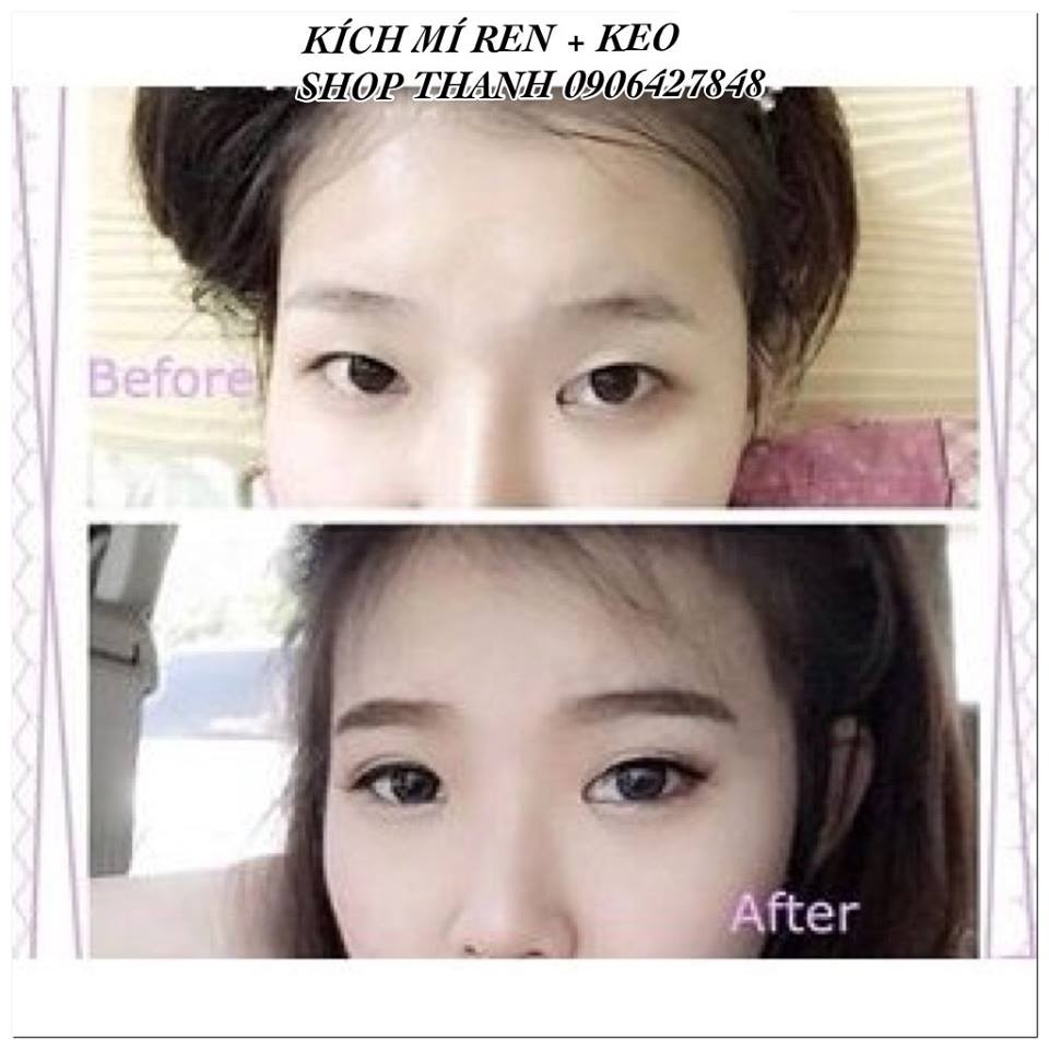 LƯỚI REN KÍCH MÍ TÀN HÌNH + KEO