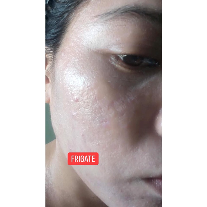 Keo Bạc FRIGATE Colloidal Silver - dành cho da mụn, da nhạy cảm, nh.iễ.m kem tr.ộ.n, demodex 30ml