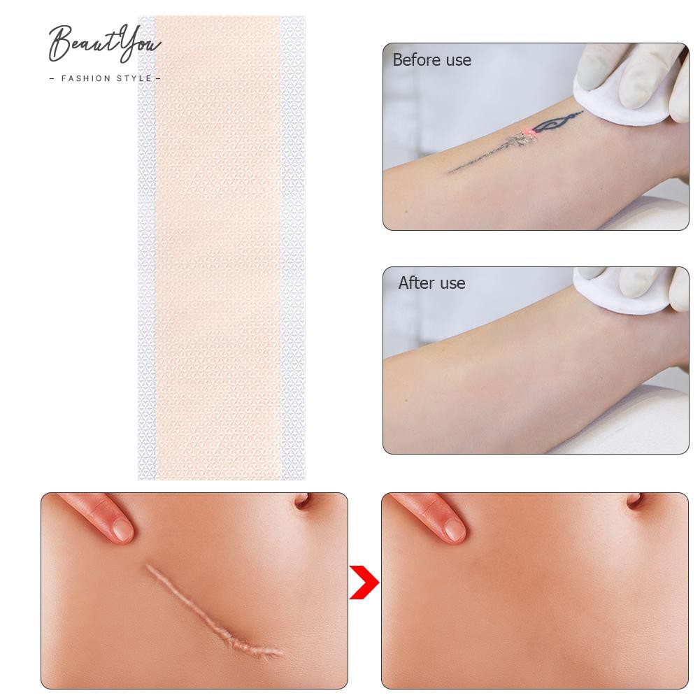 (Hàng Mới Về) Miếng Dán Che Khuyết Điểm Sẹo Mụn Vô Hình Bằng Silicone