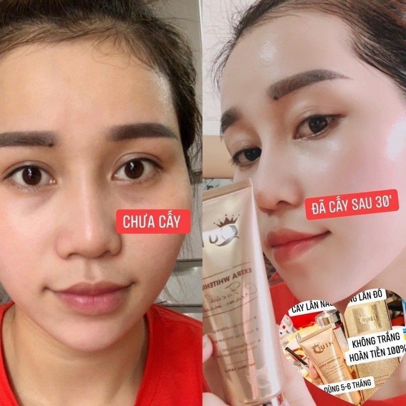 Tảo cấy trắng face Quin