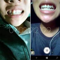 (A1+A2) Dụng cụ niềng răng cho trẻ em