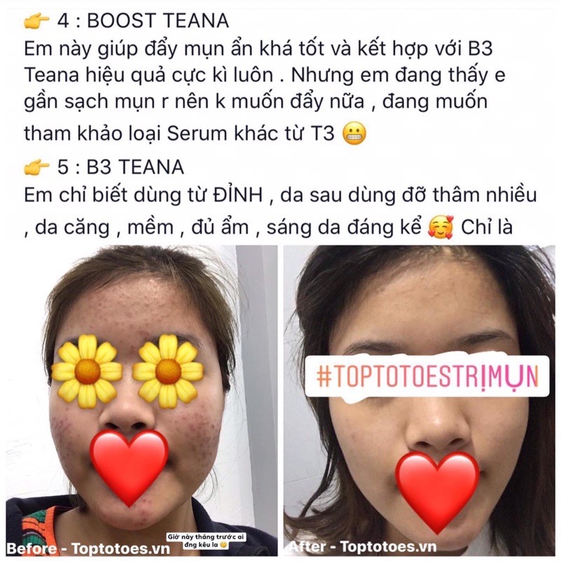 Booster Teana Natural Salicylic Acid làm sạch sâu lỗ chân lông, se cồi, ngừa và giảm mụn, cải thiện tone da