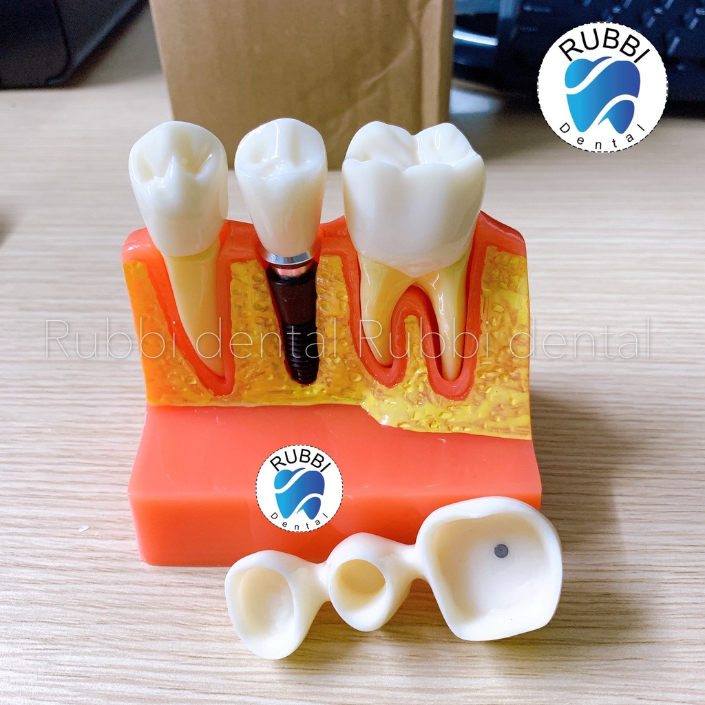 Mô hình tư vấn Implant, cầu 3 răng dùng trong Nha khoa