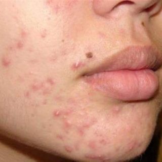 Ủ mặt  thảo dược  humnile (nhỏ)