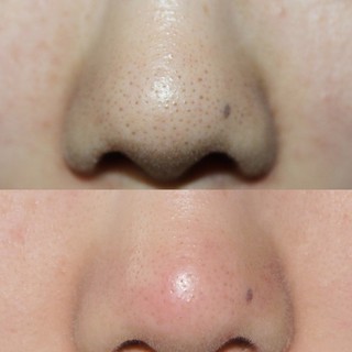 Mặt nạ Đẩy mụn Goodbye blackhead