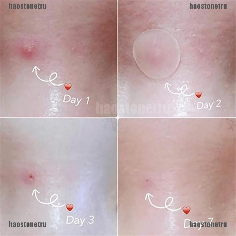 Bộ 36 Miếng Dán Mụn Hydrocolloid Và Mụn Trứng Cá