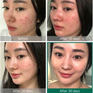 Toner aha bha pha 30 days micrale some by me ( nước hoa hồng mụn aha bha pha 30 ngày)