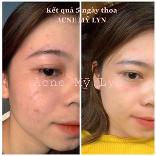 Acne Mỹ Lyn ( Kèm quà tặng )