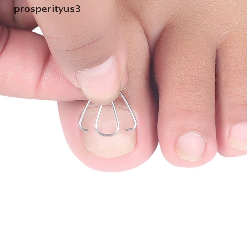 [prosperityus3] Nail Art Ingrown Toe Nail Correction Tool Toenail Nail Orthosis Paronychia Clip [new]