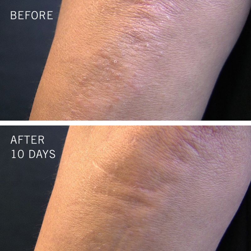 Tẩy da chết & Dưỡng thể body First Aid Beauty KP Bump Eraser Body Scrub 226g