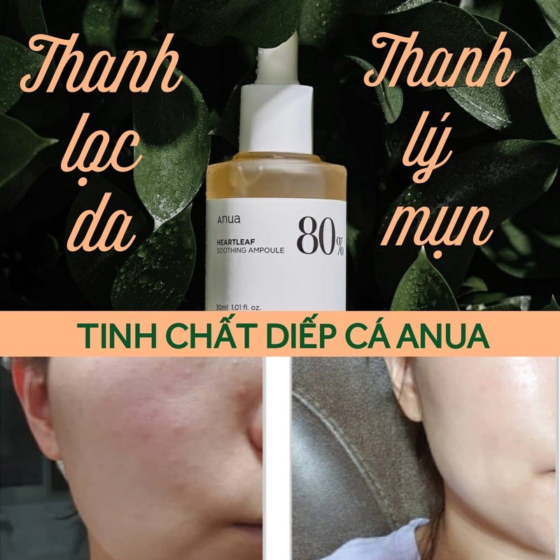 Bộ dưỡng diếp cá ANUA HEARTLEAF | BigBuy360 - bigbuy360.vn