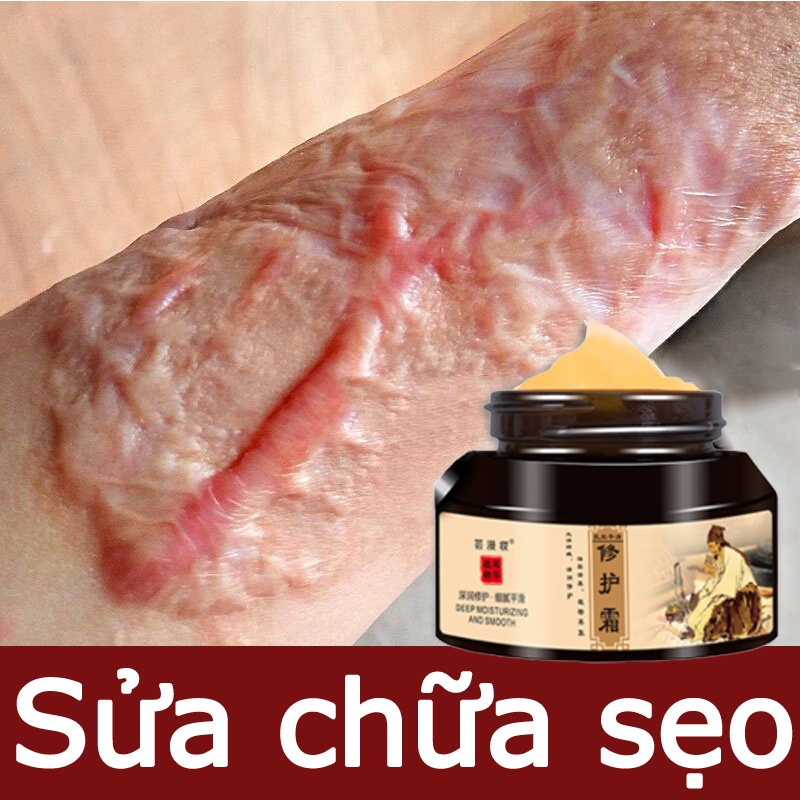 Kem xóa sẹo Kem sẹo Scar Care 50g sẹo do bị thương sẹo bỏng sẹo phẫu thuật sửa chữa tất cả các loại của vết sẹo
